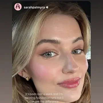beyond facials nanoneedling