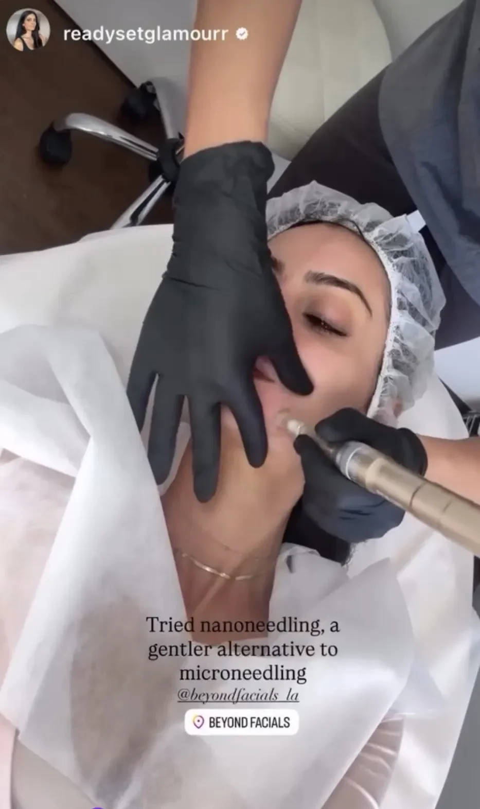 Nano Facial treatment result