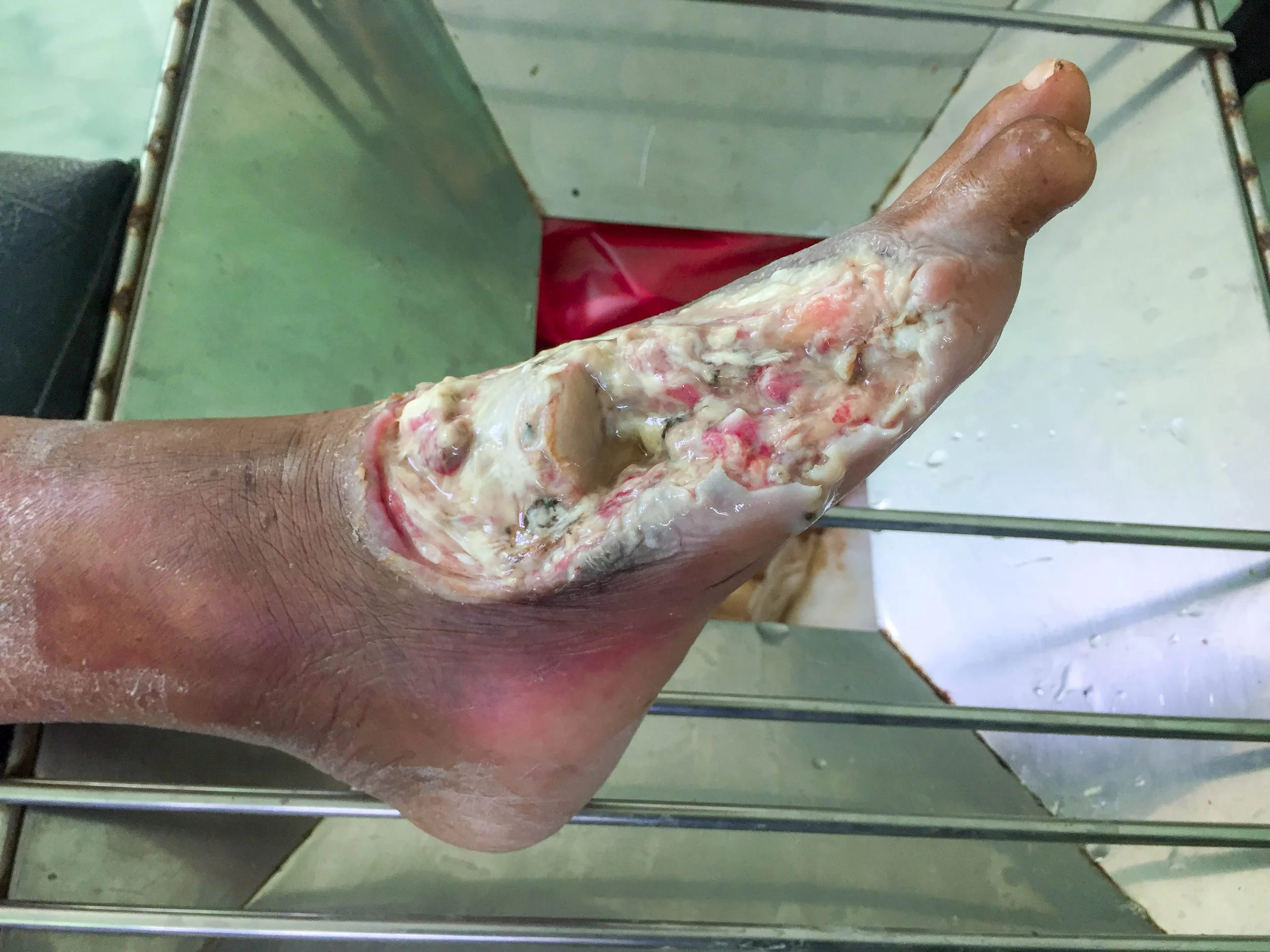 non-healing surgical wounds