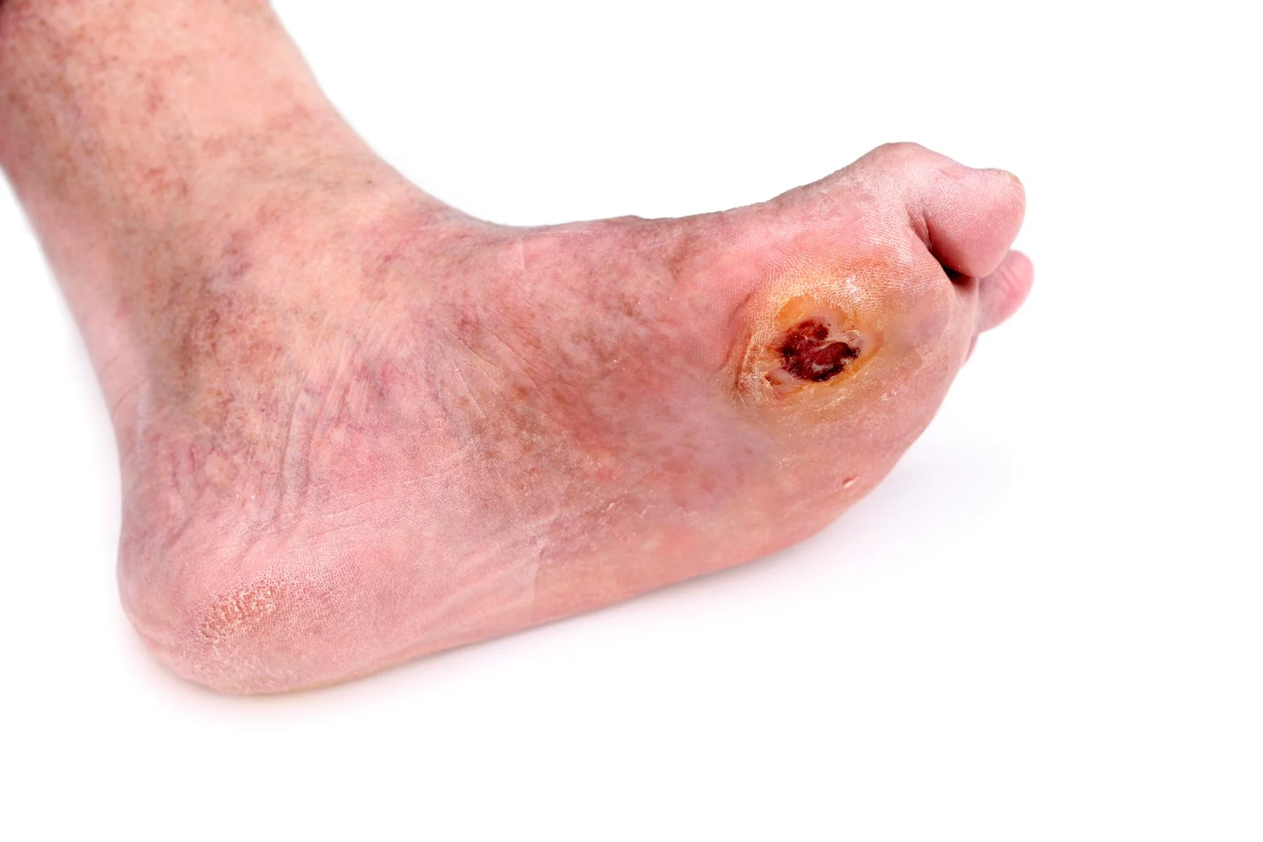 diabetic foot ulcers