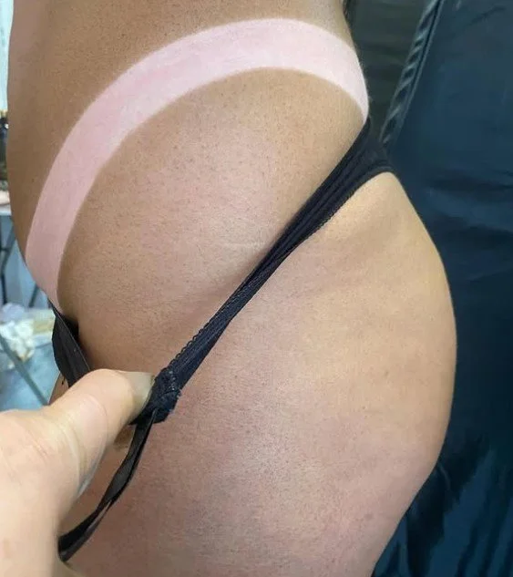 A close-up of a person's hip and buttocks, with a hand pulling down black underwear to reveal a pinkish-white band or mark on the skin.