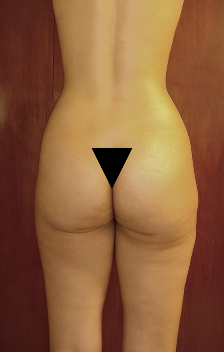 Vista de la parte trasera de un cuerpo humano desnudo, mostrando las caderas y parte de las piernas, con un triángulo negro en la zona del glúteo.