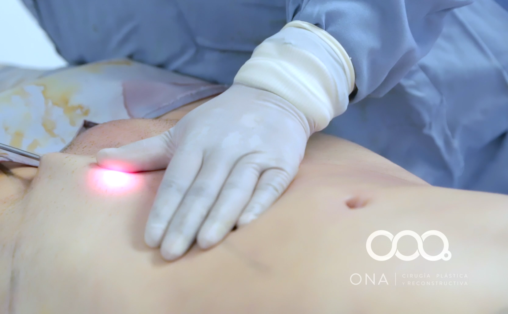 Un cirujano realiza un procedimiento en un paciente, usando guantes y equipo médico, con luz láser en la zona del abdomen.
