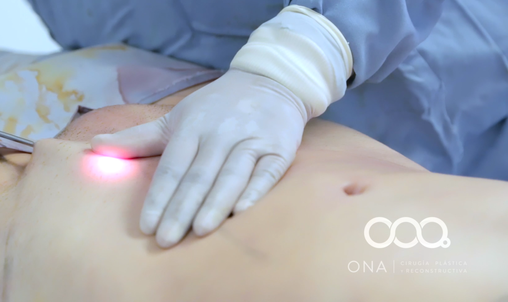 Médico realizando una cirugía plástica en el abdomen de un paciente, usando guantes y equipo médico, con logotipo de ON A Cirugía Plástica y Reconstructiva en la esquina inferior derecha.