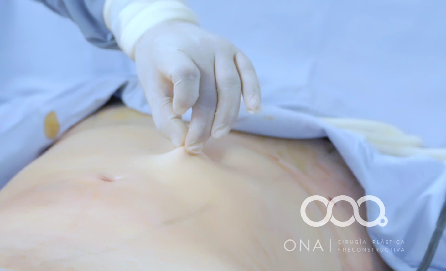 Un cirujano realiza una cirugía plástica en un paciente, usando guantes y técnicas quirúrgicas, en un entorno médico esterilizado.