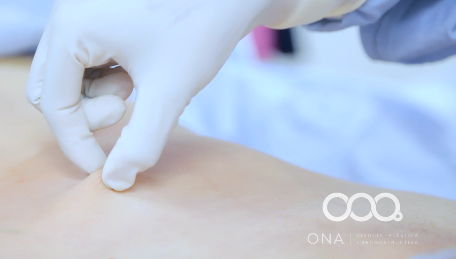 Mano con guantes de latex realizando una extracción o prueba en el abdomen de una persona, en un entorno clínico.