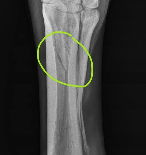 A Bone to Pick