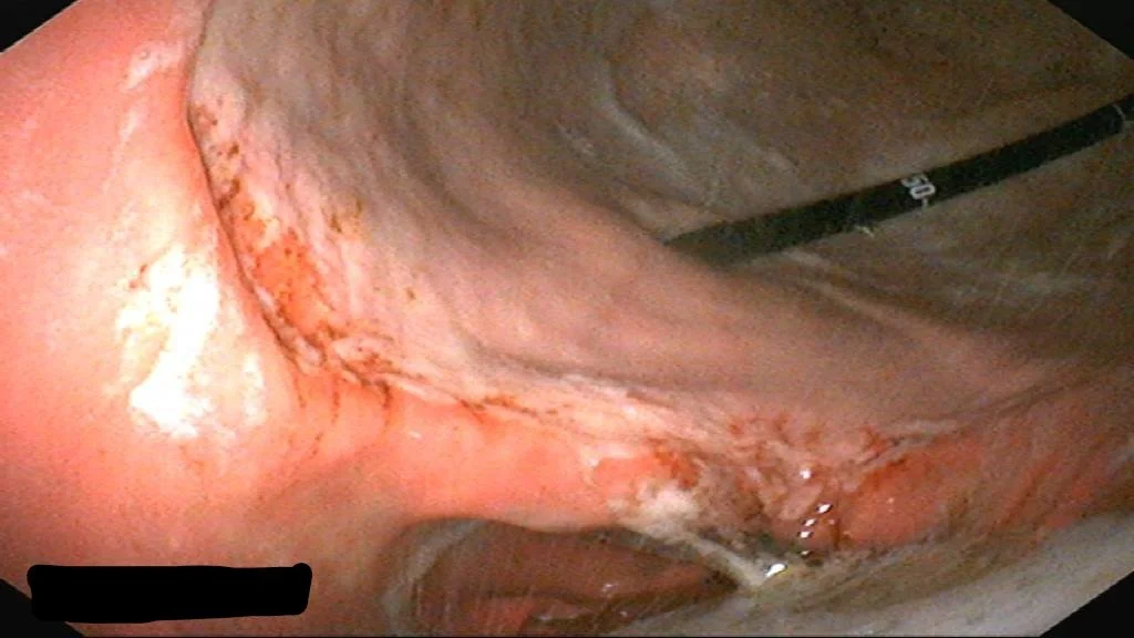 Gastroscopy Explained