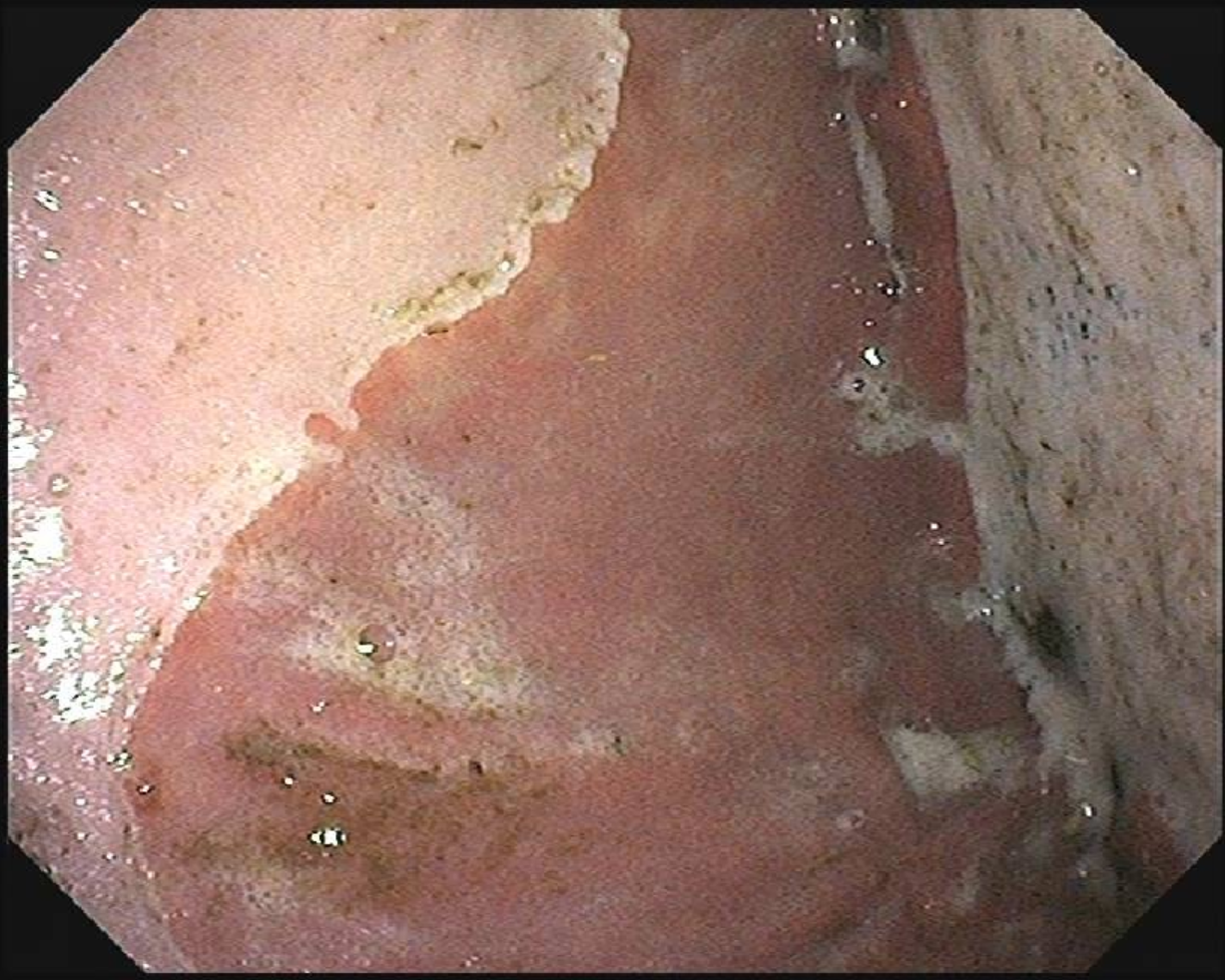 Equine Gastric Ulcer Syndrome