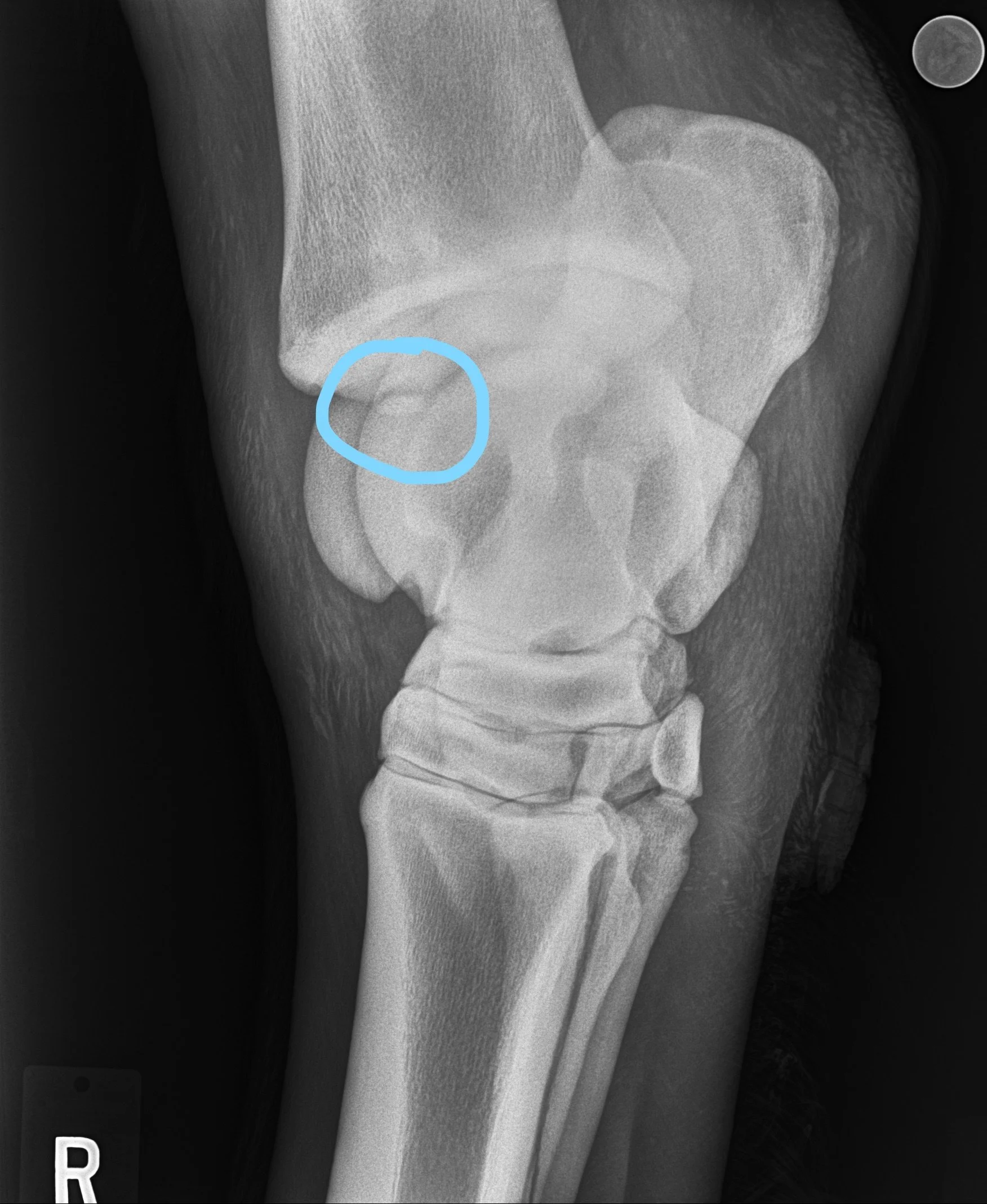 Osteochondritis dessicans (OCDs)