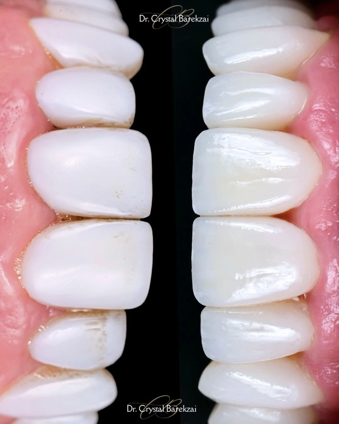 Unpopular opinion: whiter doesn&rsquo;t always mean better.

This patient came in with older composite veneers that were ultra bulky, overly opaque, stained, and an unnaturally bright white. They lacked texture, translucency, anatomy, and dimension, 