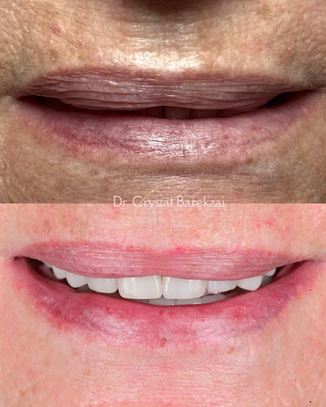 She told me she avoided smiling for years. 

No tooth display, an open bite, and a lot of lost confidence. 

Seeing her smile again after treatment was everything. She said she couldn&rsquo;t wait to finally smile without thinking about it. 

It&rsqu