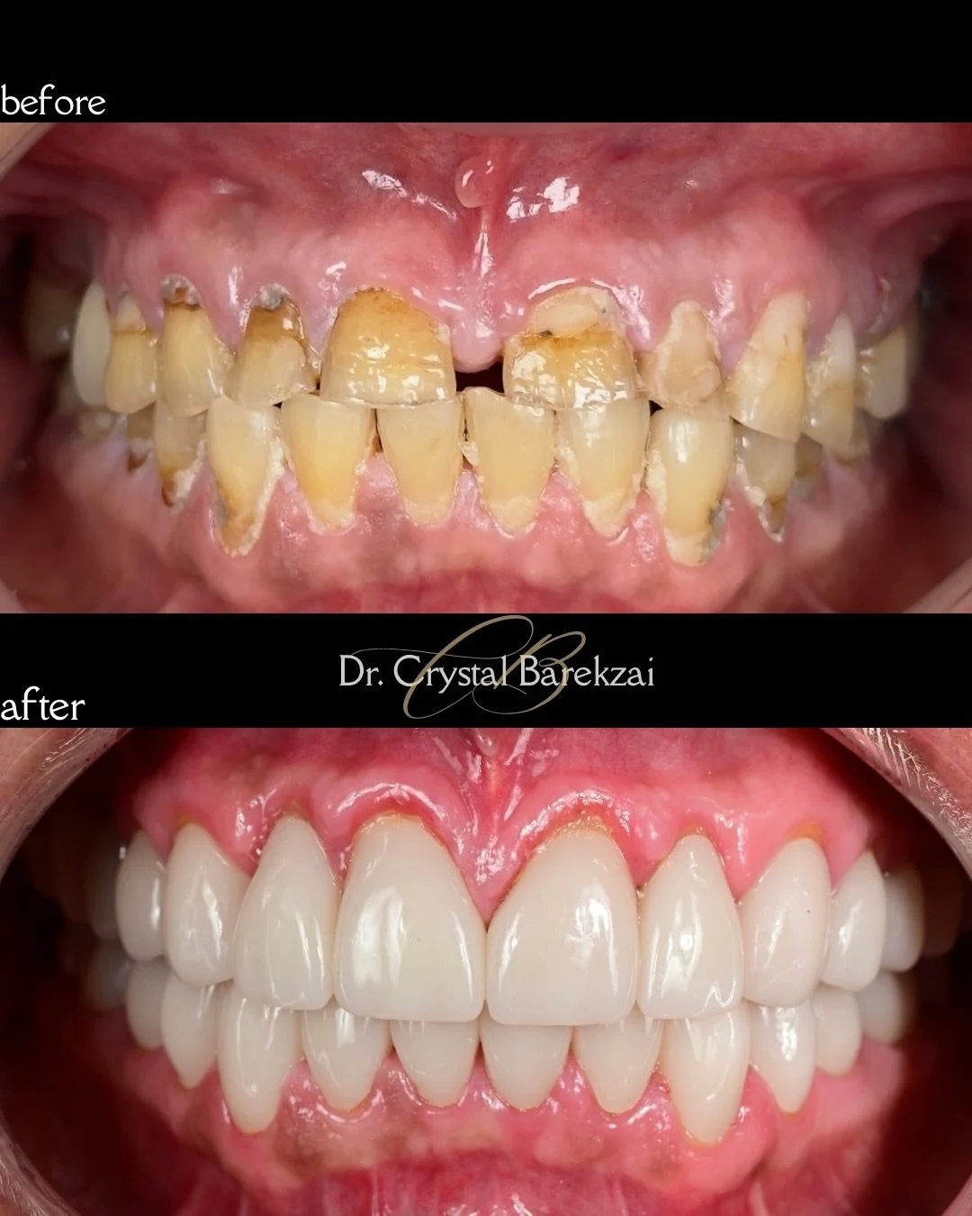 Full mouth rehabilitation is not just about choosing the most aesthetic ceramic. Sometimes it is about choosing what will truly change someone&rsquo;s life.

This patient came in with severe clenching and grinding, advanced wear, and a collapsed bite