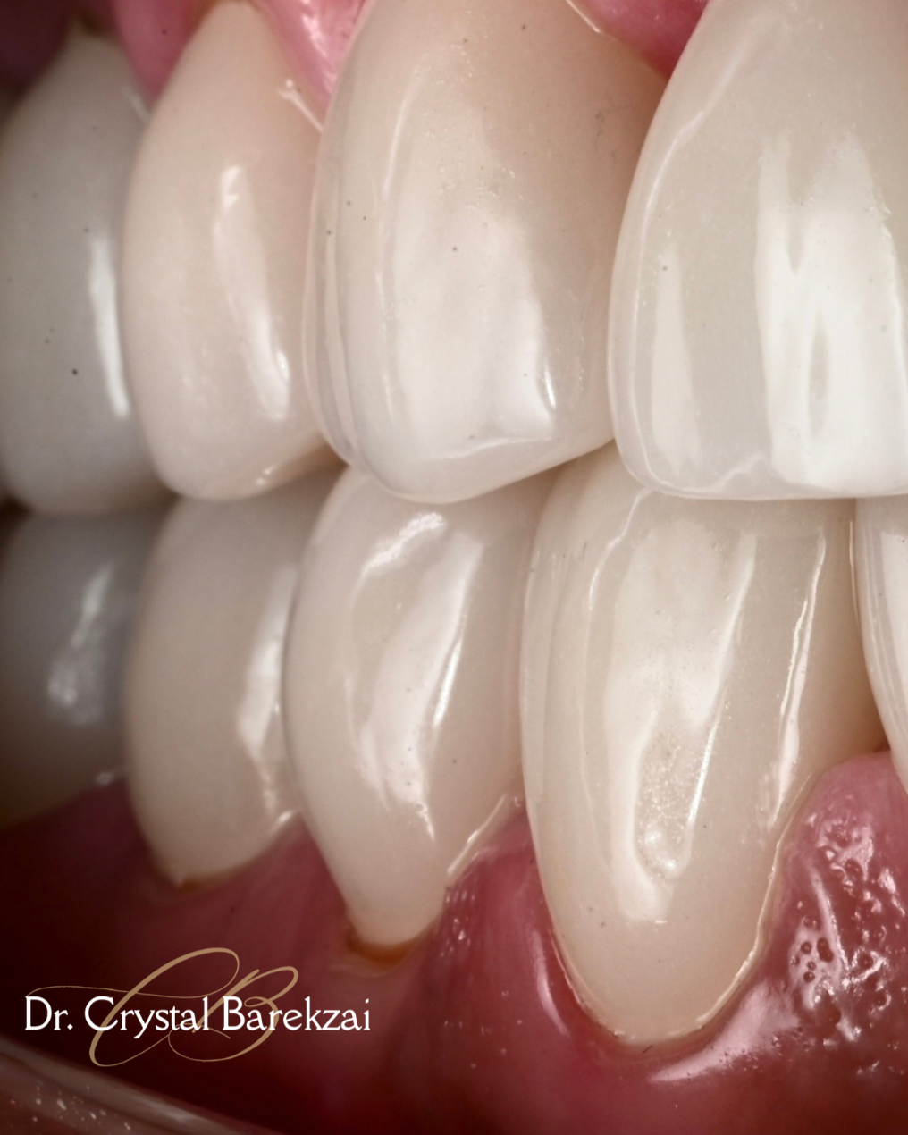 Close-up of teeth with dental restorations or crowns in a person's mouth, with visible gum tissue. veneers, crowns