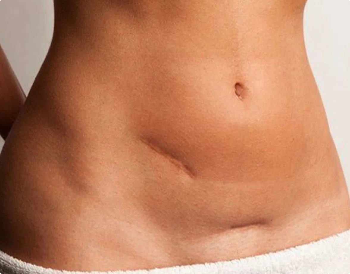 Anti-FIbrosis Support Therapy