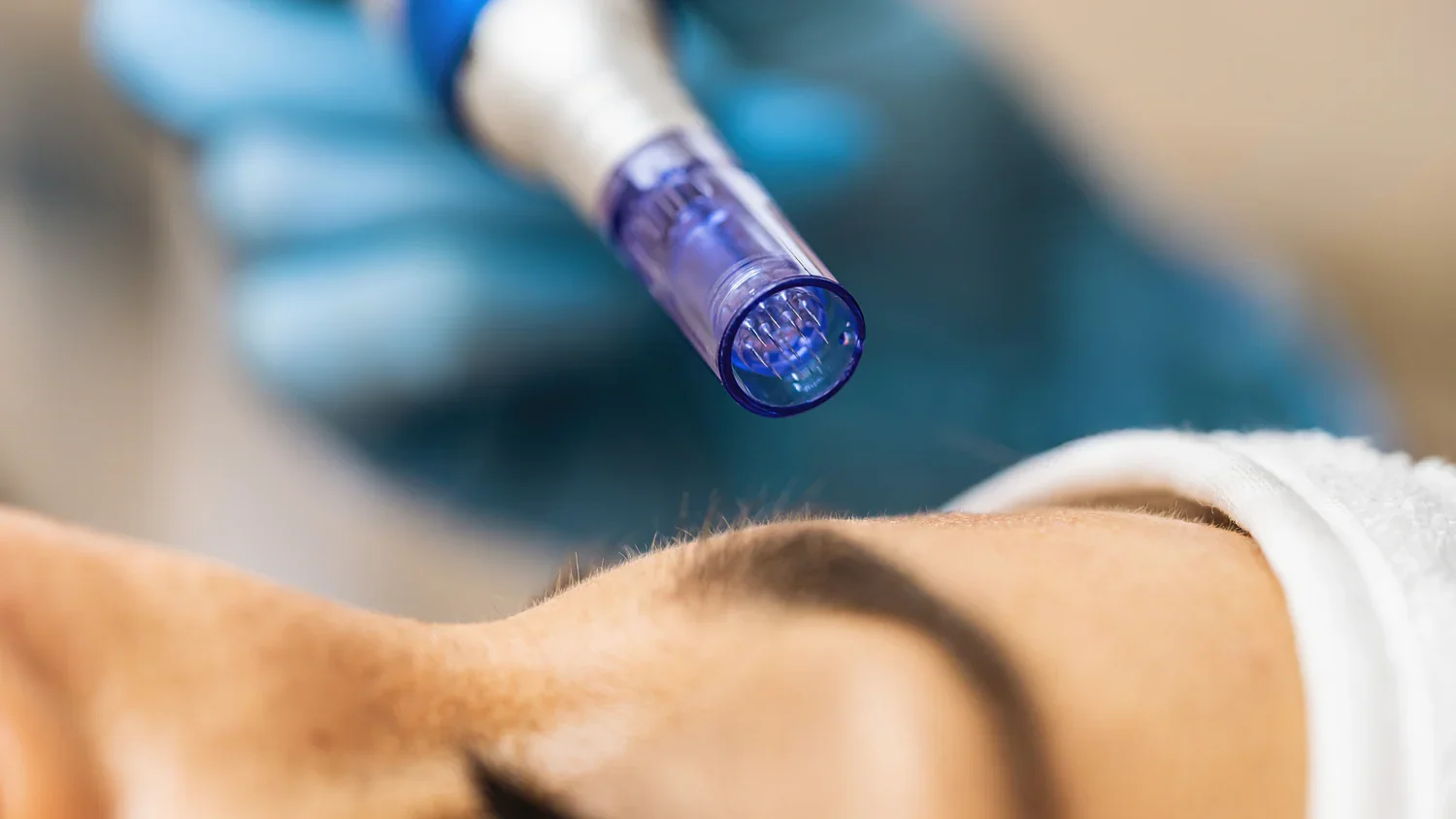 Advanced Microneedling Infusion