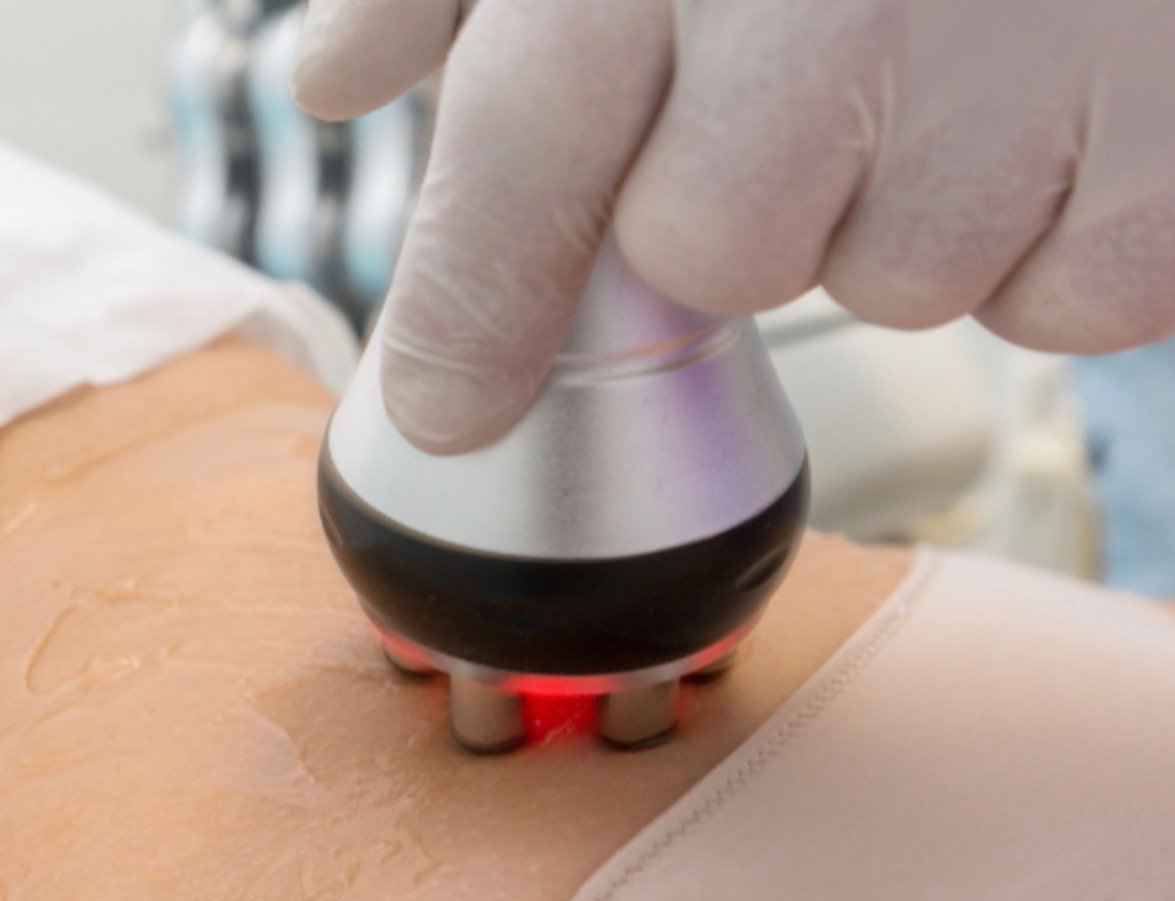 Skin Tightening Radiofrequency
