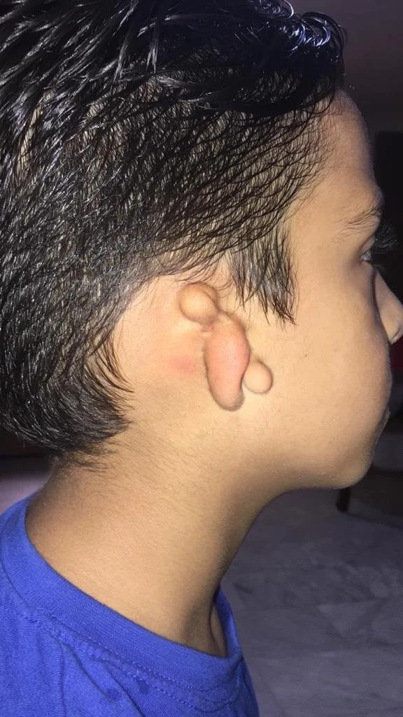 Side profile of a young boy with a large cauliflower ear caused by trauma, with wet dark hair and wearing a blue shirt.
