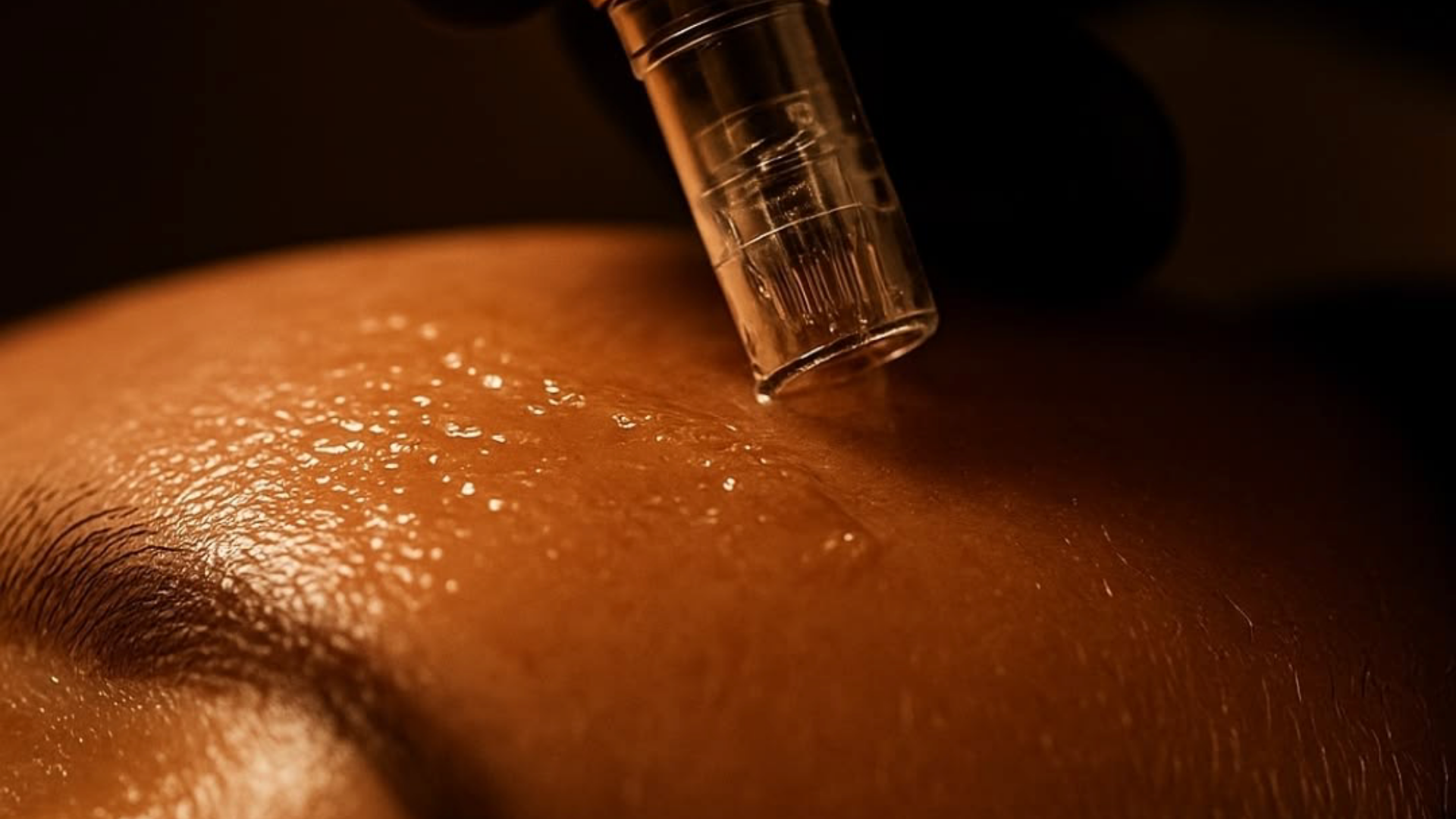 Medspa in Newport Beach, CA 92660 l Microneedling Near Me