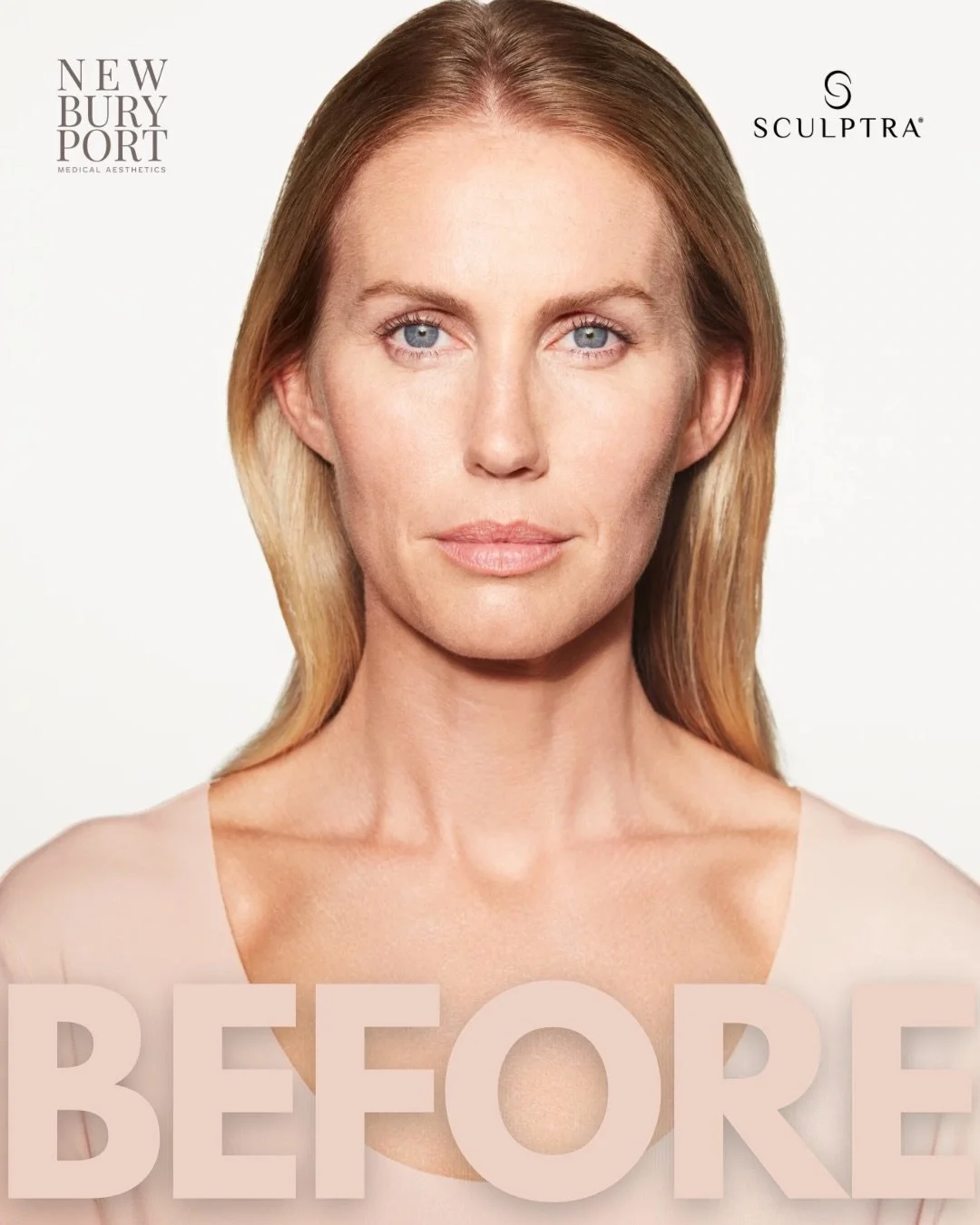 Still thinking about Sculptra? There&rsquo;s still time&hellip; but not much ⏳✨

These before &amp; after results show the power of collagen stimulation. Sculptra works gradually by helping your body rebuild its own collagen for natural-looking volum