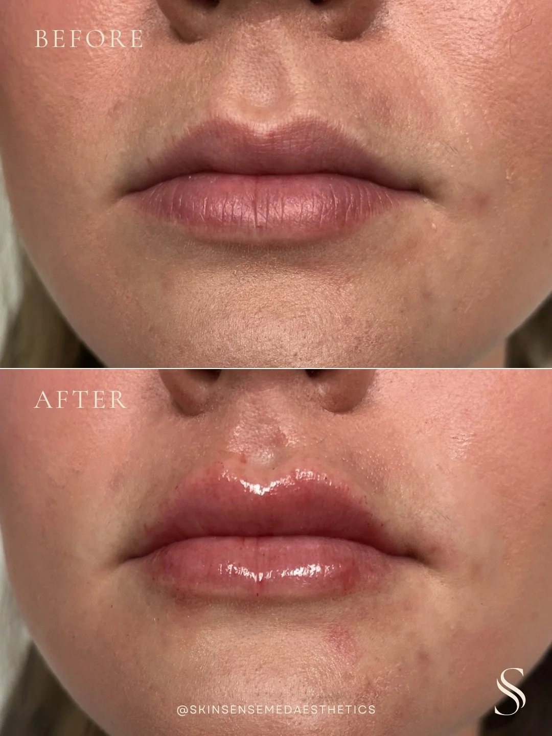 Just a lil&rsquo; more volume please...

This lip filler transformation was all about enhancing shape, balance, and softness, while keeping everything natural and aligned with her features.

At Skin Sense, every treatment is customized based on your 
