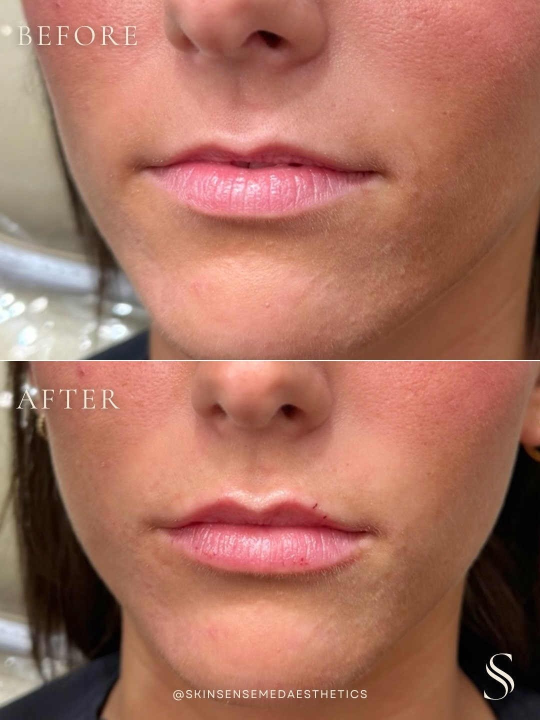 The first 5 people to book a lip filler appt with us for Friday, May 29 (TOMORROW) will receive a FREE GIFT! 💋

DM us &ldquo;LIPS&rdquo; and we&rsquo;ll send you the link to view our availability!
