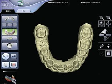 Amprentarea dentară digitală