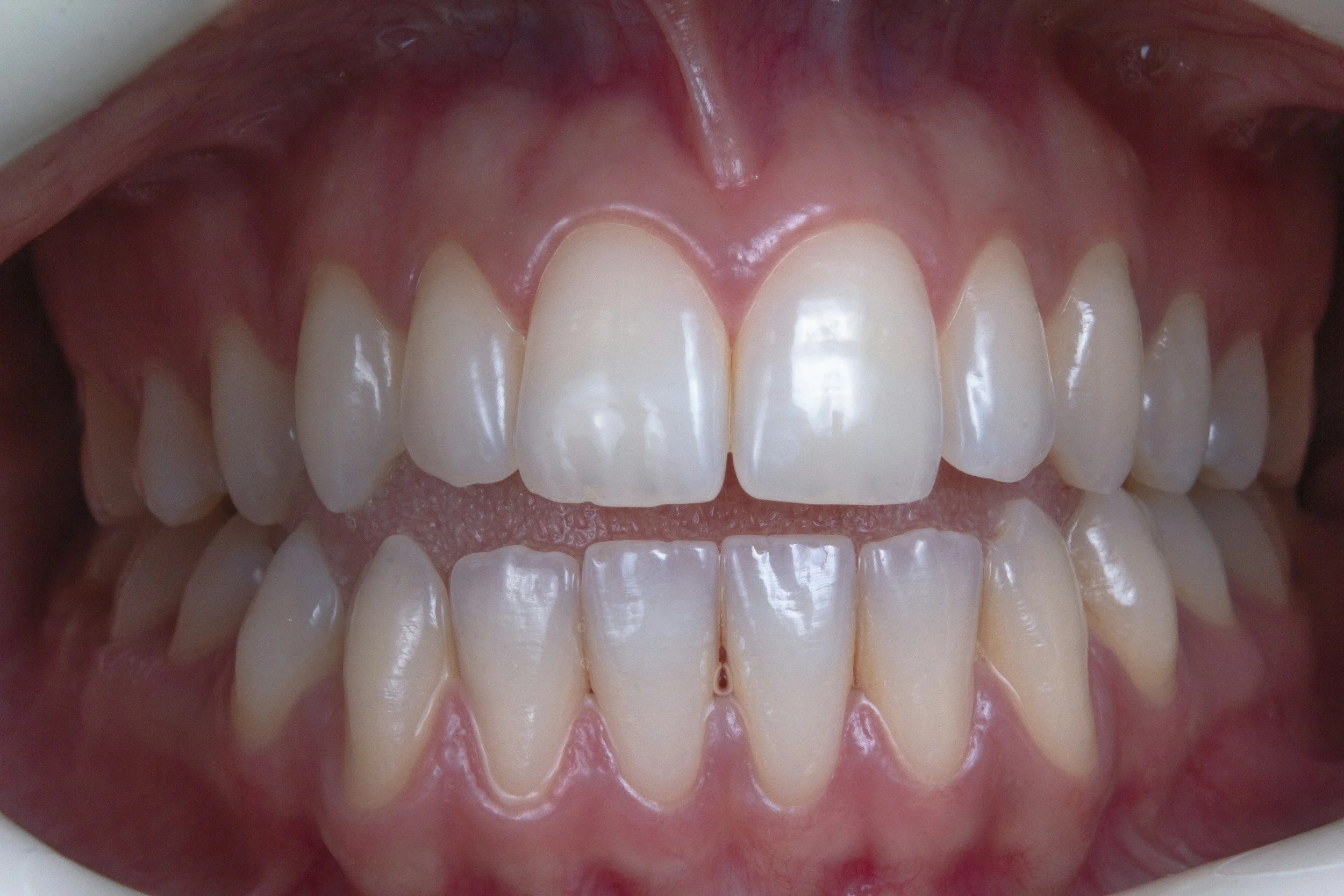 Zâmbetul gingival poate fi tratat cu succes de medicul stomatolog