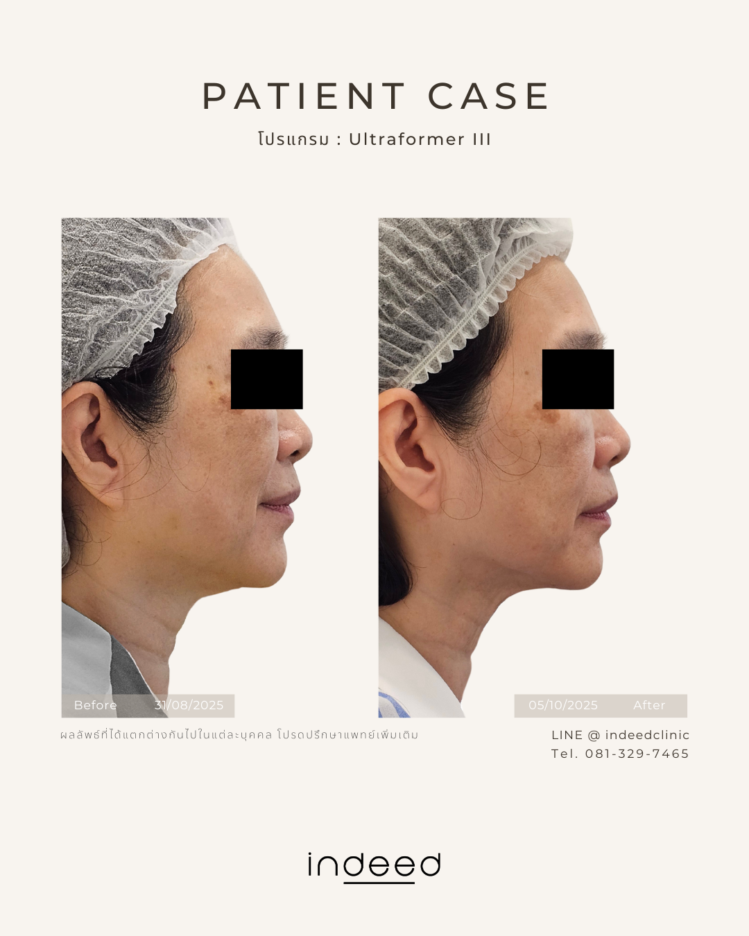 B&A - Ultraformer.png