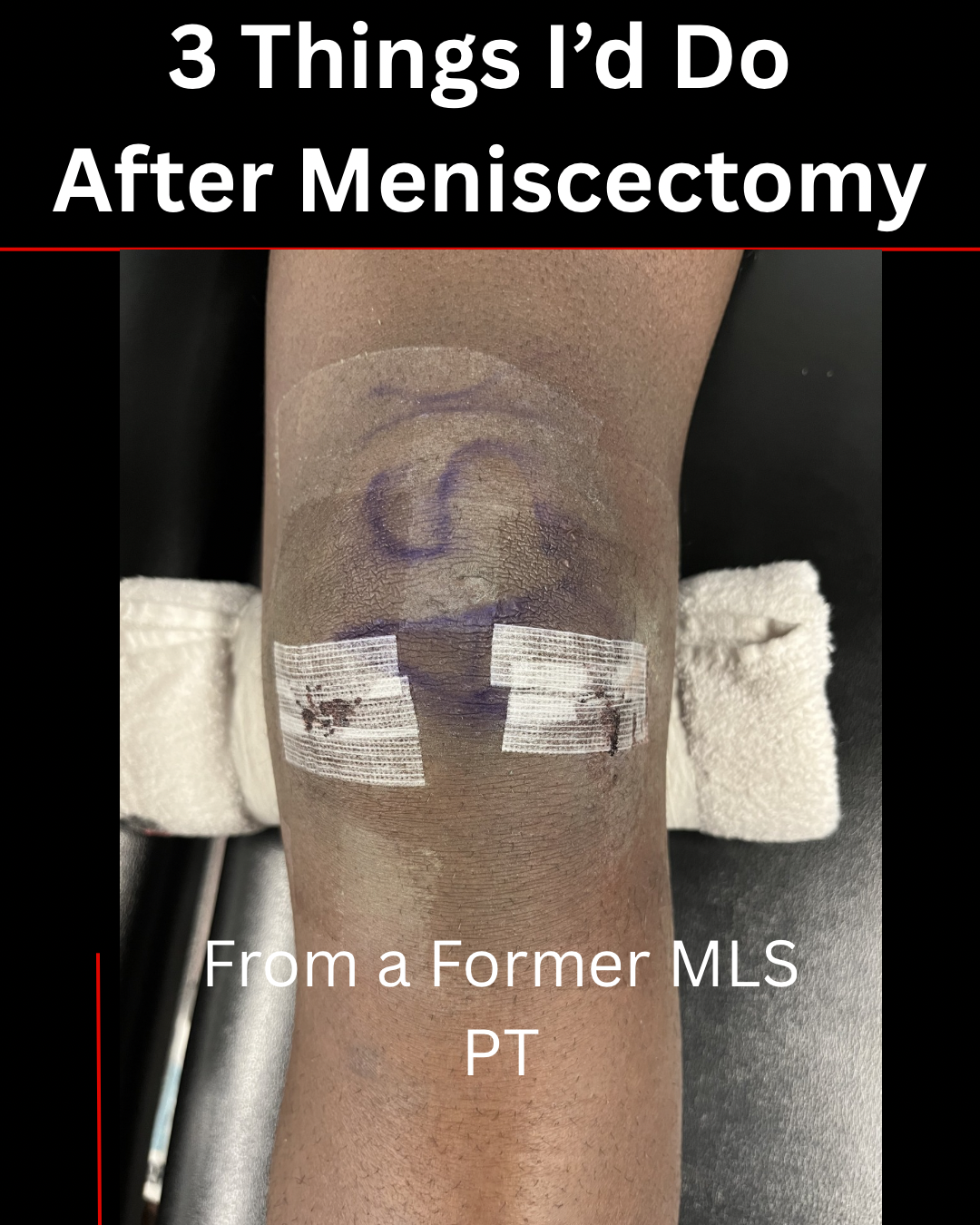 Partial Meniscectomy Recovery: 3 Major Mistakes Athletes Make After Surgery