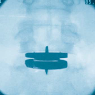 Lumbar artificial disc implant used for lower back pain at Texas Disc Replacement Center by Dr. Antonio Webb