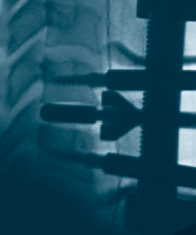 Cervical disc implant used in neck surgery by Dr. Antonio Webb at Texas Disc Replacement Center, a spinal fusion alternative