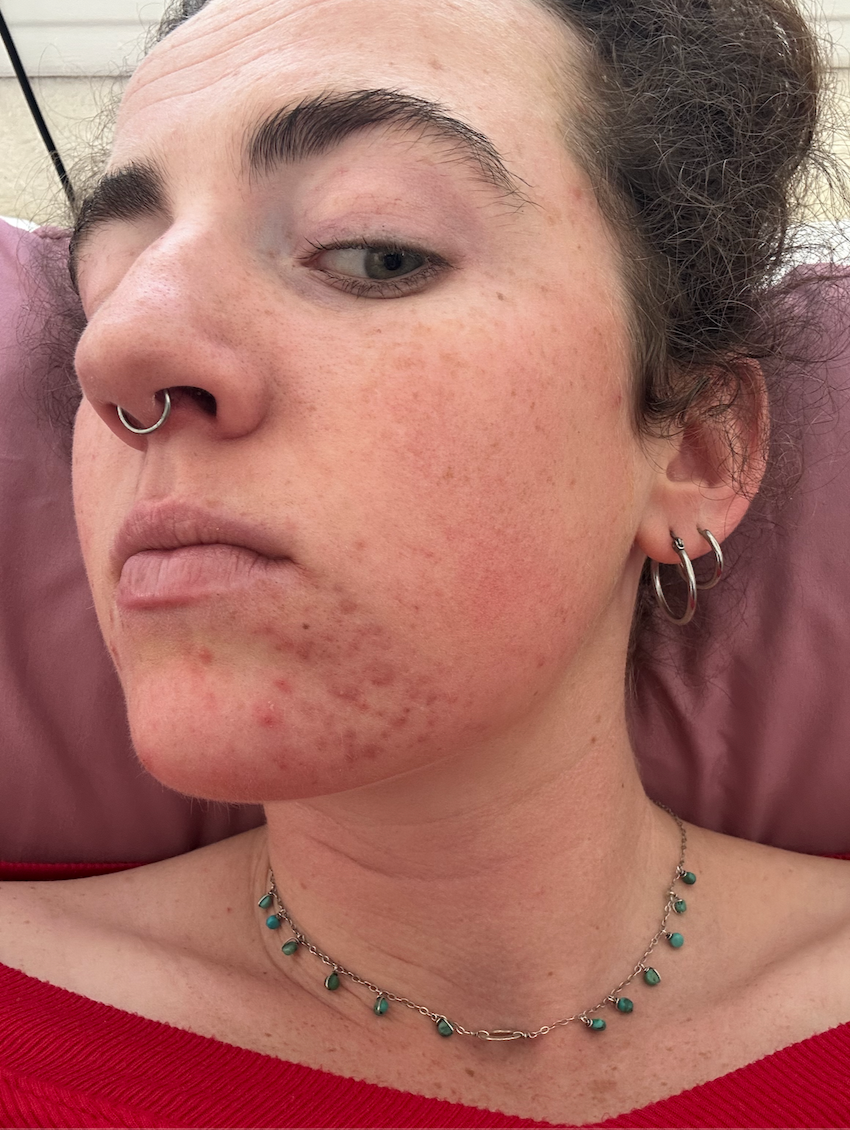 My Acne Journey