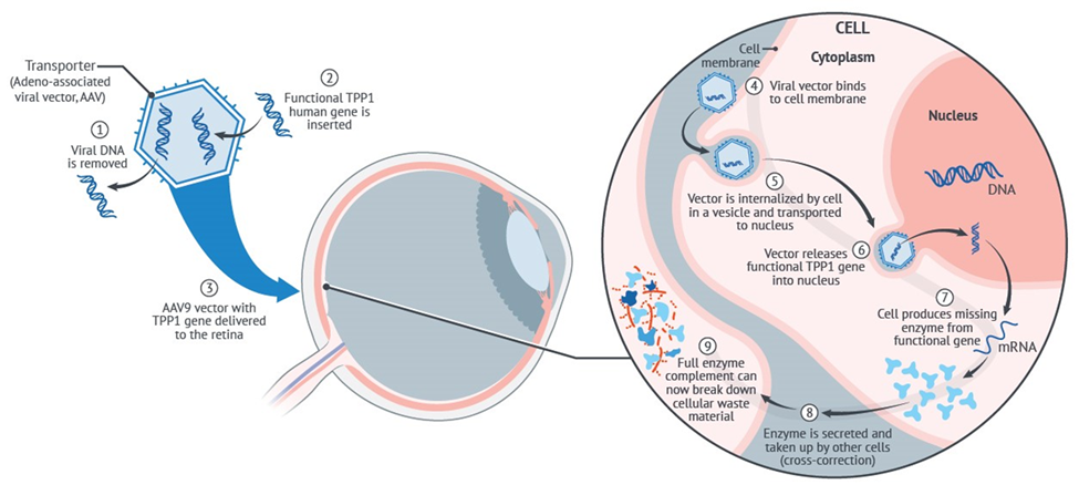 Diagram showing gene therapy process for retinal cells, involving removal of viral DNA, insertion of a functional gene into a viral vector, and delivery into the cell nucleus to produce a missing enzyme for cellular waste breakdown.