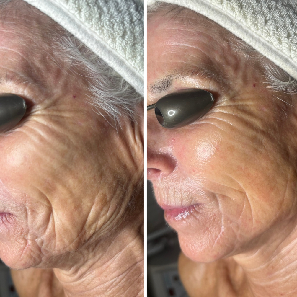 Close-up of an elderly woman's face before and after treatment. Her face is very tight and toned, looks like she had a facelift.