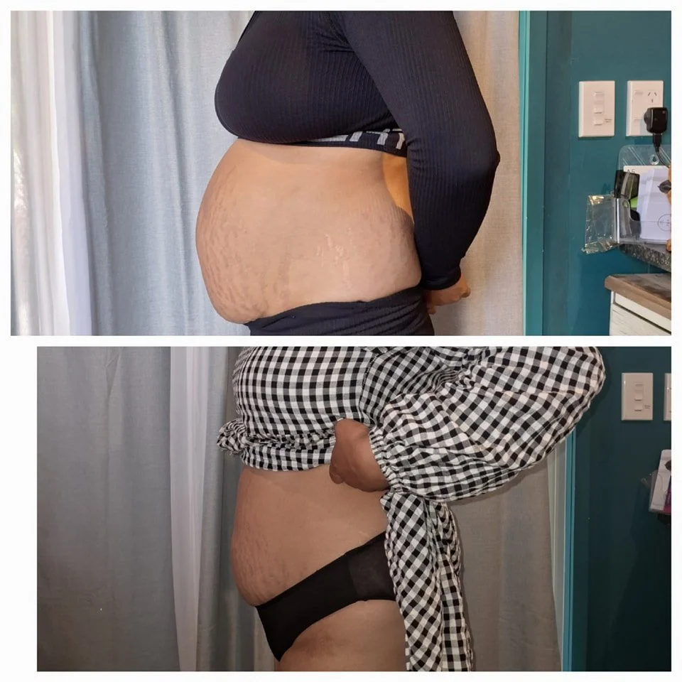 Side-by-side comparison of a person's abdomen, showing before and after weight loss or body transformation. The top image shows a larger, more protruding belly, while the bottom image shows a slimmer waist with less protrusion.