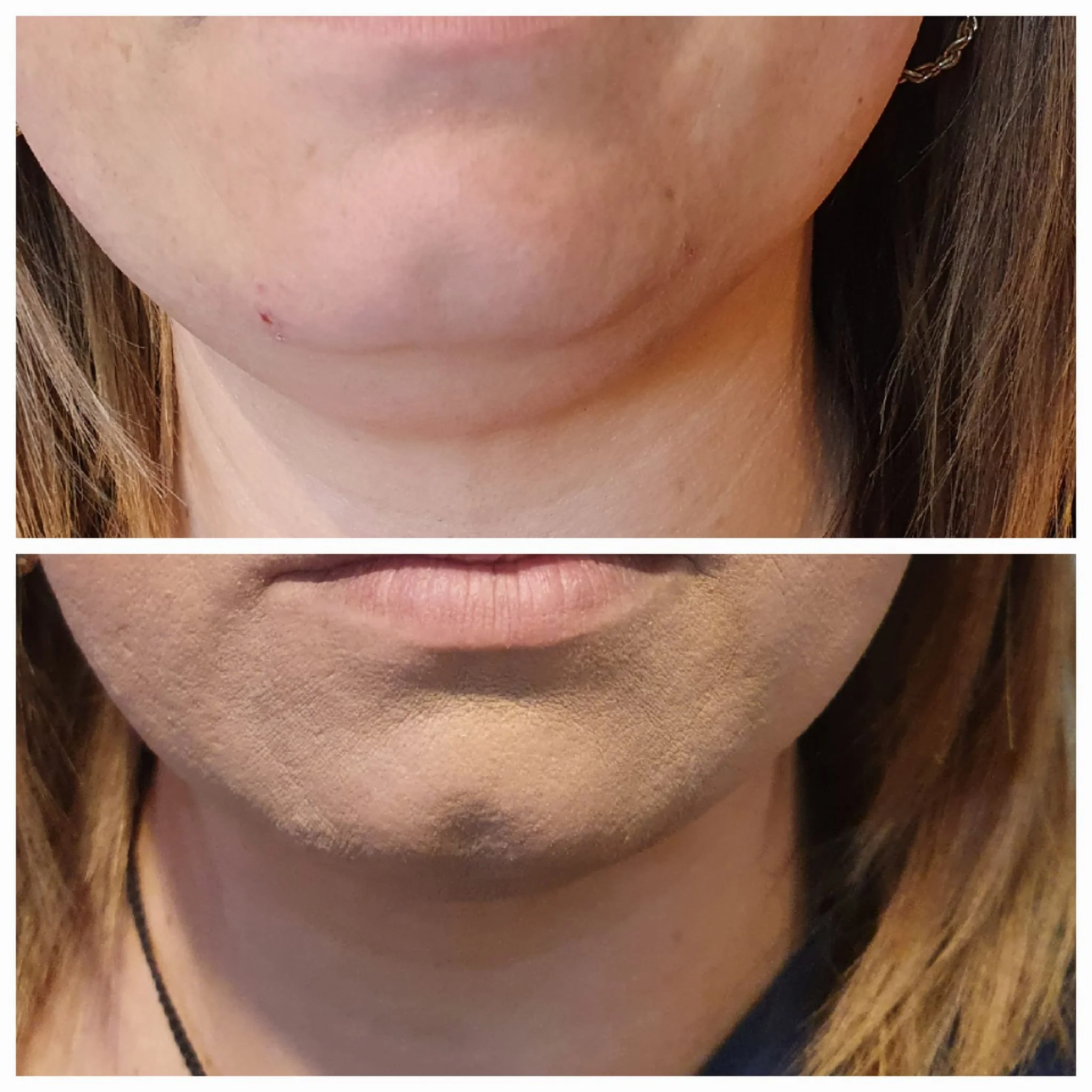 Close-up images of a woman's chin and mouth showing before and after skin improvement, with smoother reduced blemishes in the bottom image.