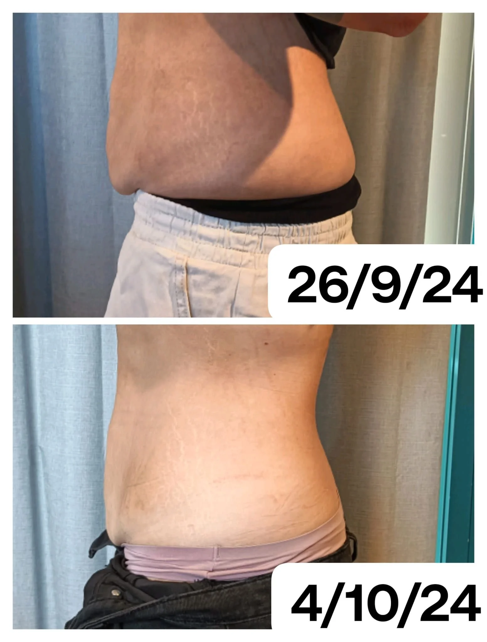 Comparison of a person's abdomen, showing significant weight loss from September 26, 2024, to April 10, 2024.