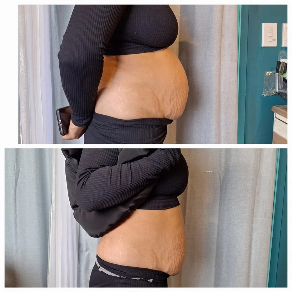 Side-by-side comparison of a person's abdomen, showing significant weight loss and reduction in stretch marks.