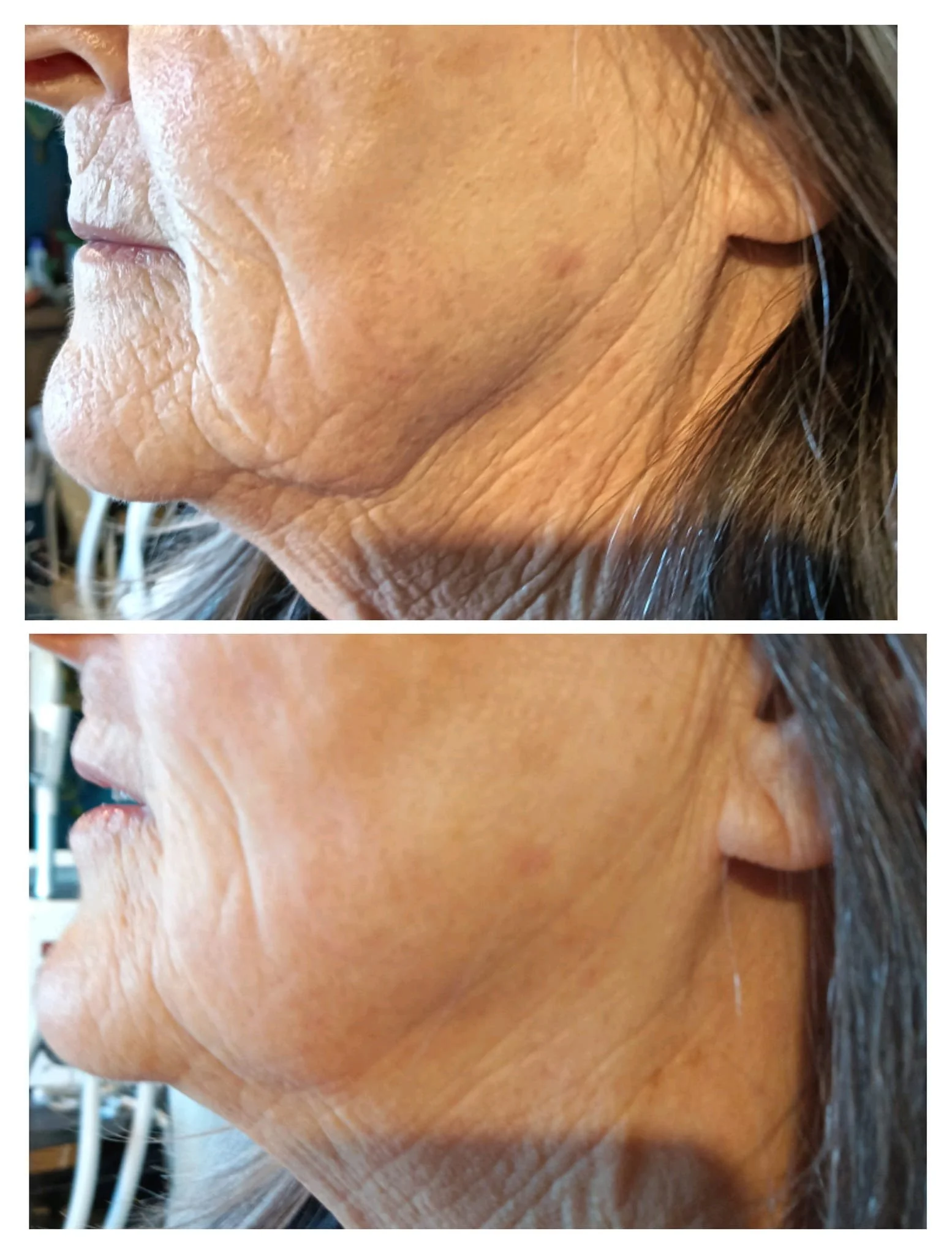 Side-by-side comparison of an elderly woman's face showing reduced wrinkles and improved skin smoothness after a skincare treatment.