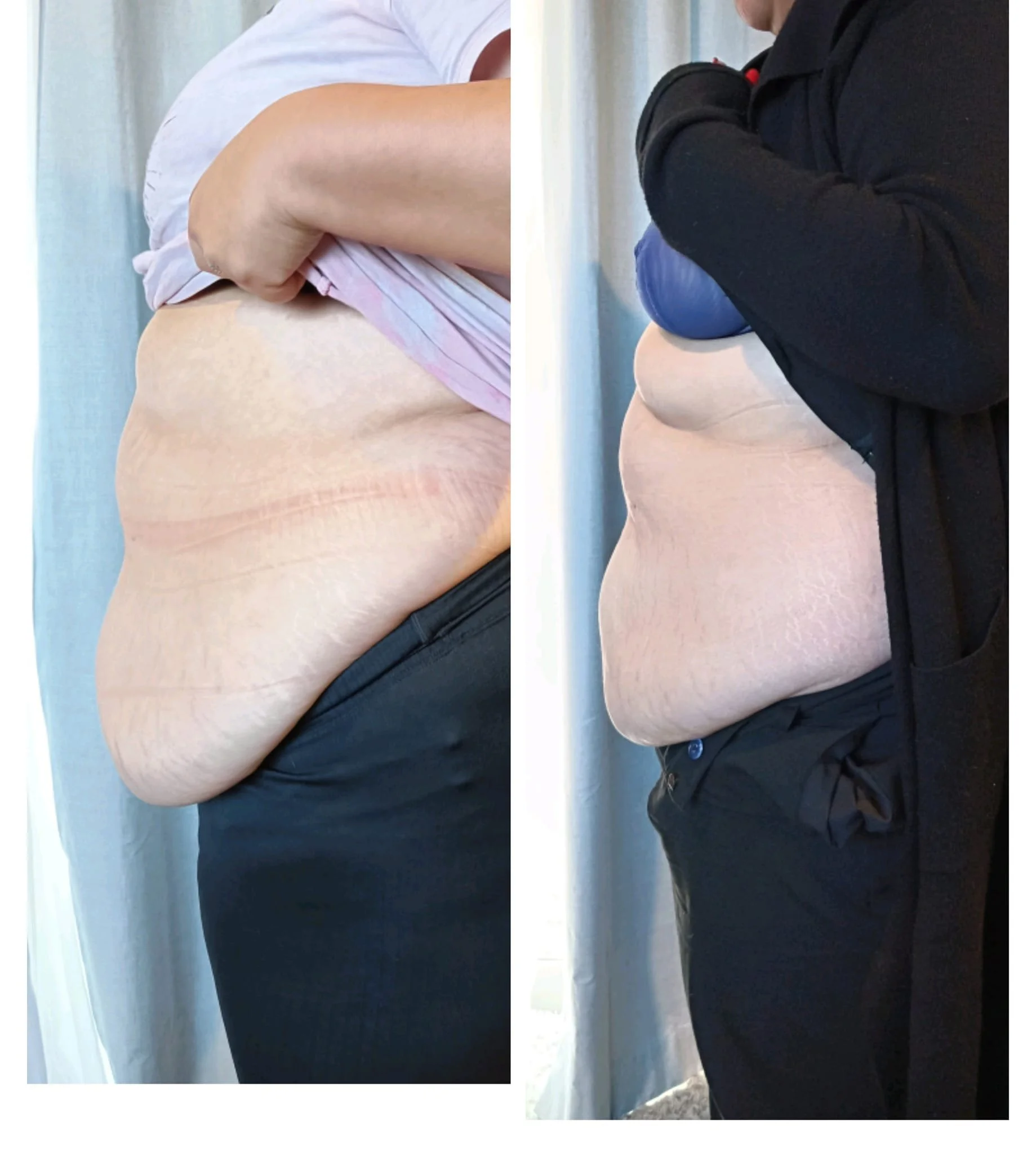 Side-by-side comparison of a person's abdomen before and after weight loss, showing reduced size and loose skin.