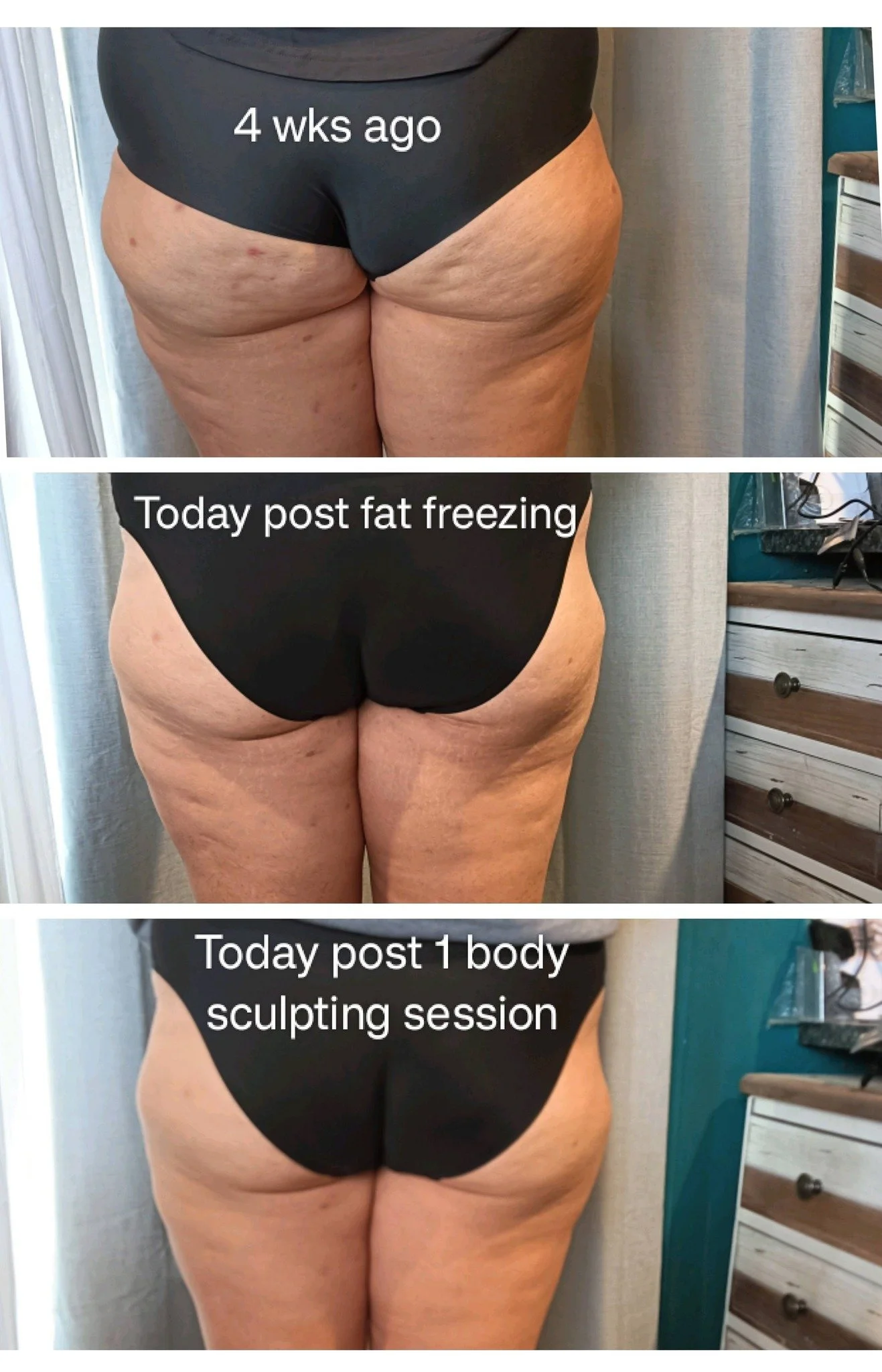 Before and after photos of a person's lower body showing results of fat freezing and body sculpting session, with captions indicating the time frames and procedures.