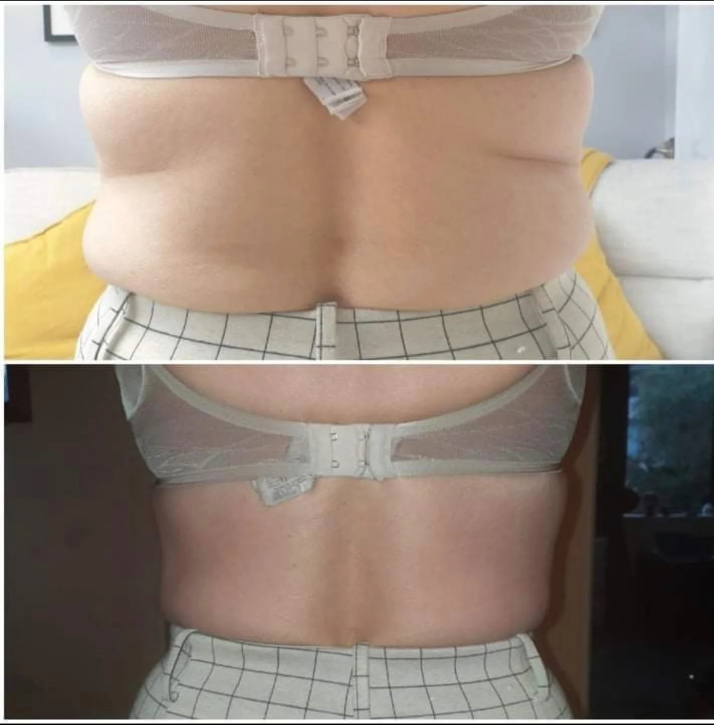A side-by-side comparison of a person's back before and after a skin tightening treatment, showing a noticeable reduction in back rolls.