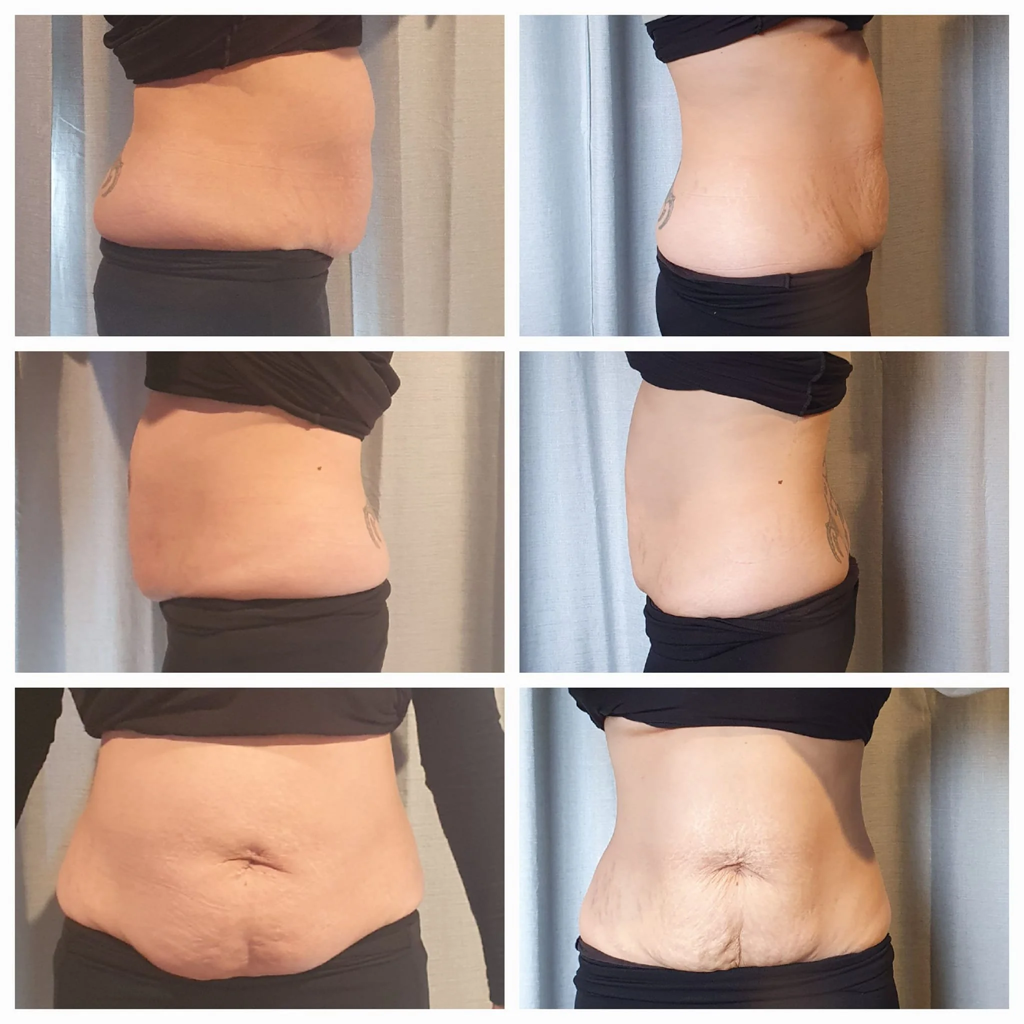Comparison of a person's abdominal area before and after weight loss, showing significant reduction in size and skin tightening.