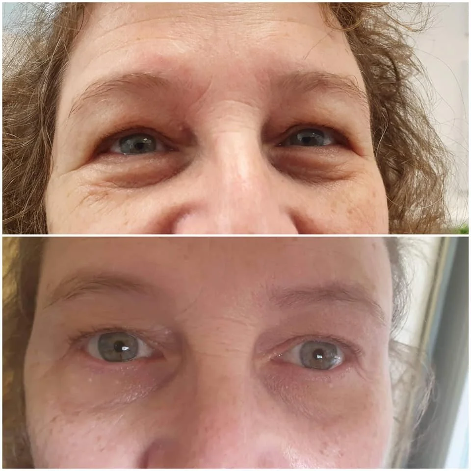 Comparison of a person's eyes before and after cosmetic treatment, showing reduction in under-eye bags and wrinkles.