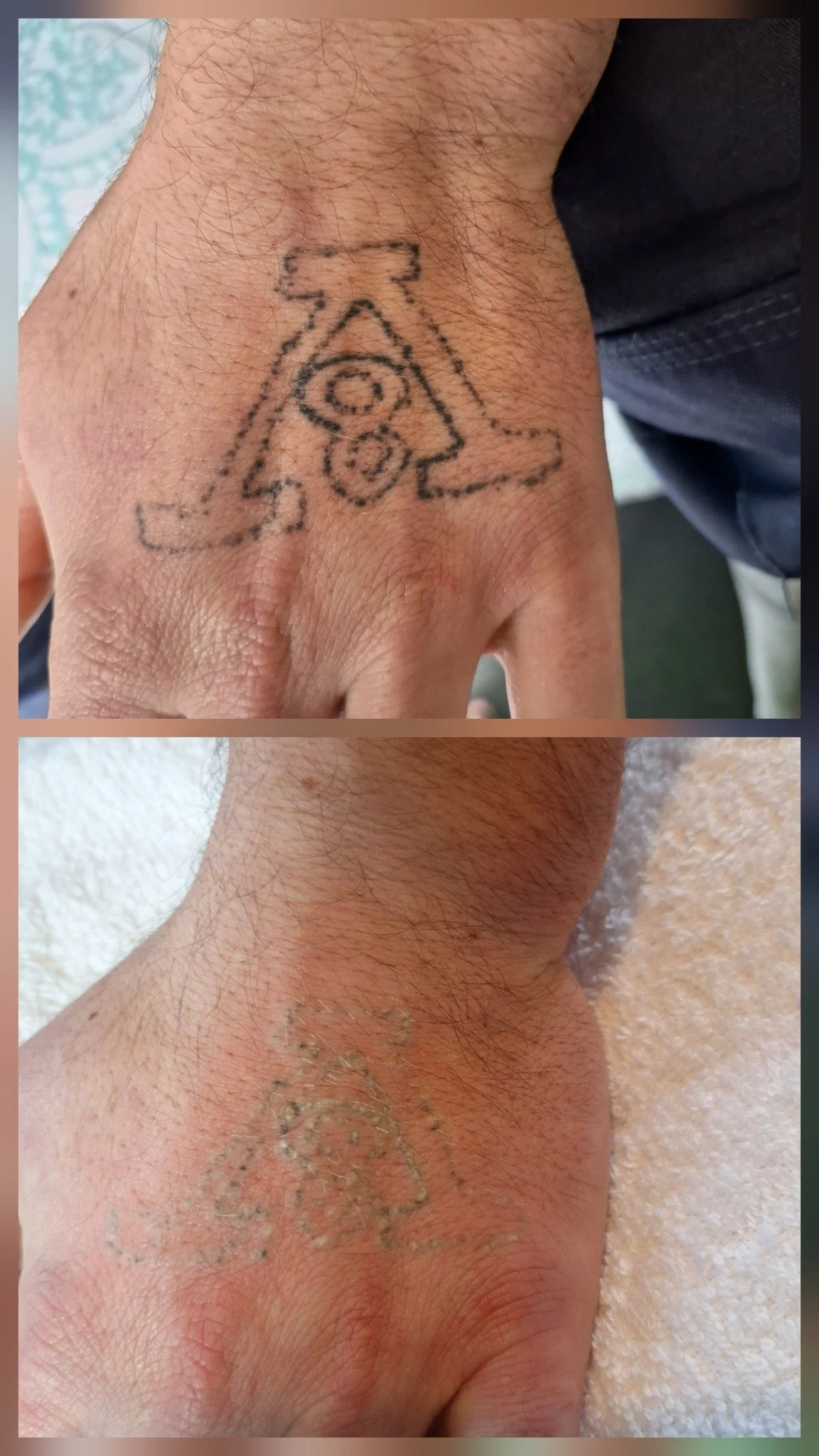 Side view of a hand with a tattoo of a machine gun on the top, showing before and after removal.
