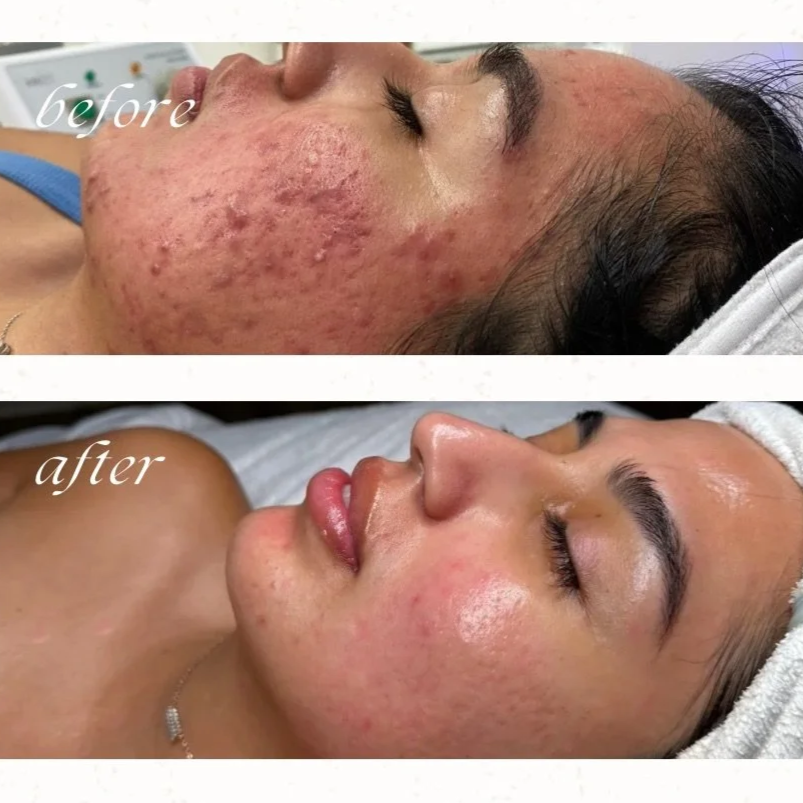 Acne Management