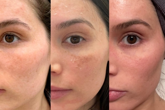 Pre/Post Glycolic Peel