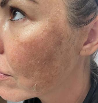 5 Days Post TCA Peel