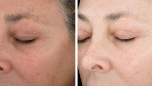 Sun Damage Relief Routine 6 Weeks